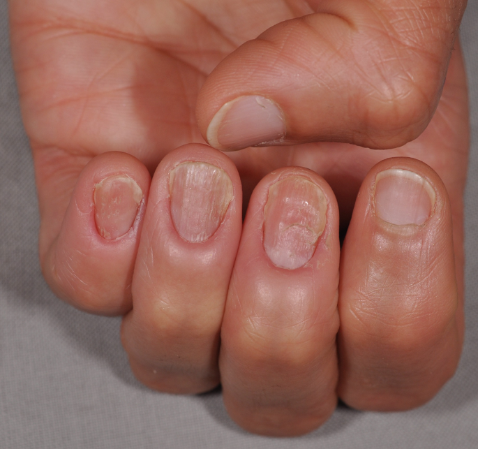 Paronychia, Swollen Finger Inflammation Due To Bacterial Infection on a Man  Hand. Wound Infection on the Skin Stock Image - Image of diabetes, disease:  228215819