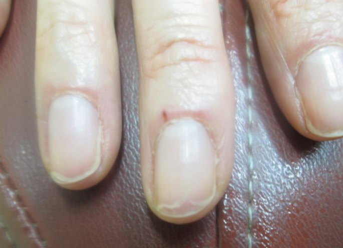 Brown spot on my Pinky toe nail : r/Melanoma
