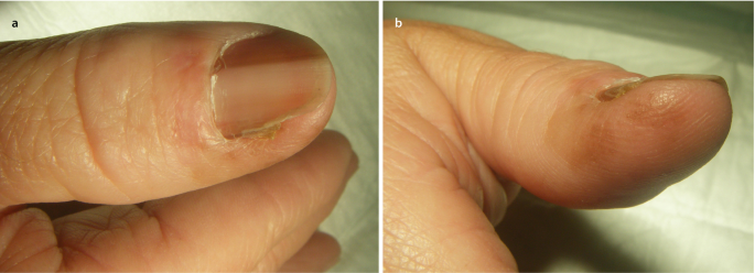 Nail lesions due to nail biting in patient 3. | Download Scientific Diagram