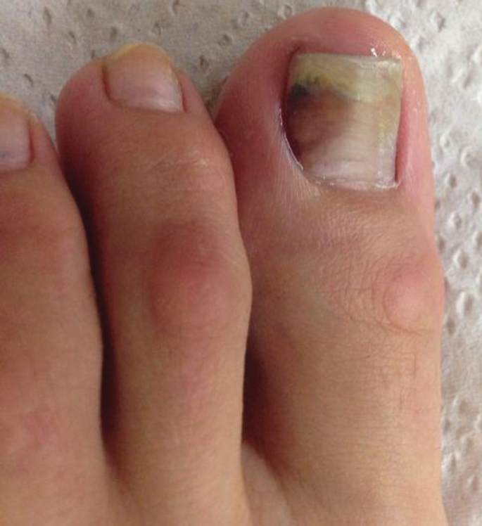 Suffering from Ingrown Toenails? | New Jersey Podiatric Physicians &  Surgeons Group, LLC