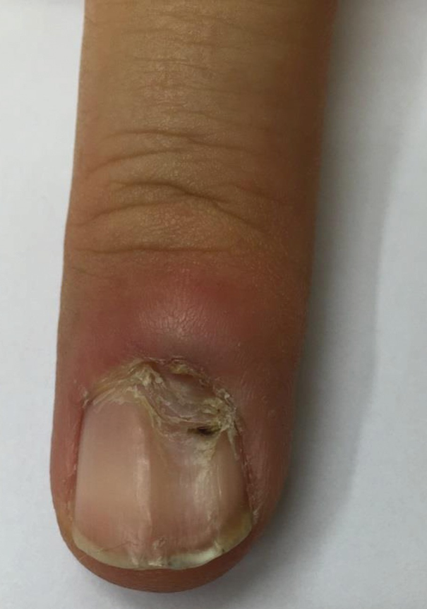 Painful Nail | SpringerLink Painful Nail | SpringerLink