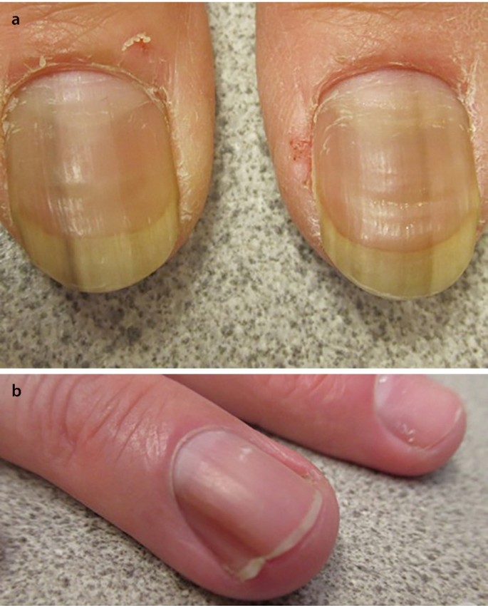 PDF] Evaluation of pigmented lesions of the nail unit. | Semantic Scholar