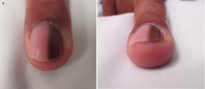 PDF) Nail discoloration occurring after 8 weeks of minocycline therapy