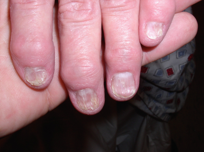 Treatment Outline for Common Nail Problems | SpringerLink Treatment Outline for Common Nail Problems | SpringerLink