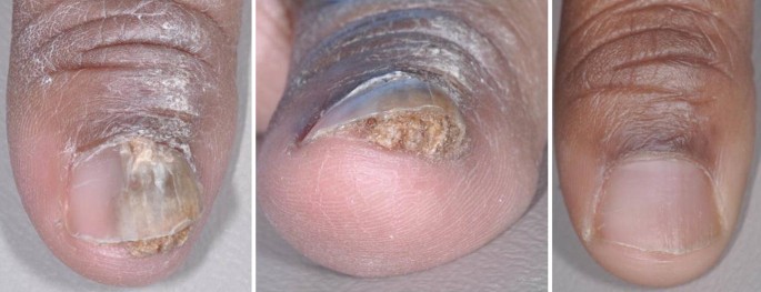An Atlas of Diseases of the Nail (The Encyclopedia of Visual Medicine)