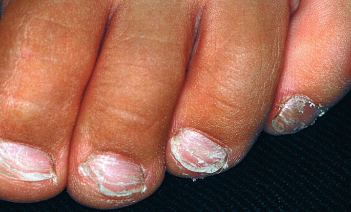 Pediatric Nail Disorders and Selected Genodermatoses with Nail Findings |  SpringerLink
