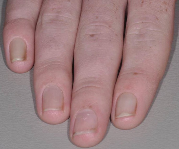20 nail dystrophy syndrome - Stock Image - C055/9834 - Science Photo Library