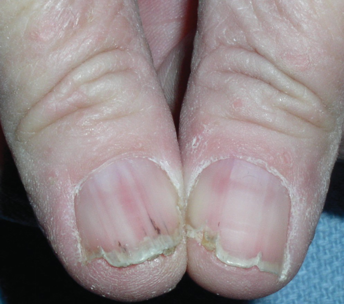 An Atlas of Nail Disorders, Part 3 | Consultant360