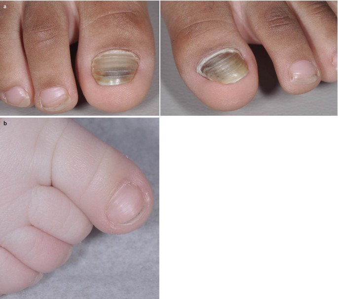 Antifungal nail patches | Tecniwork.it