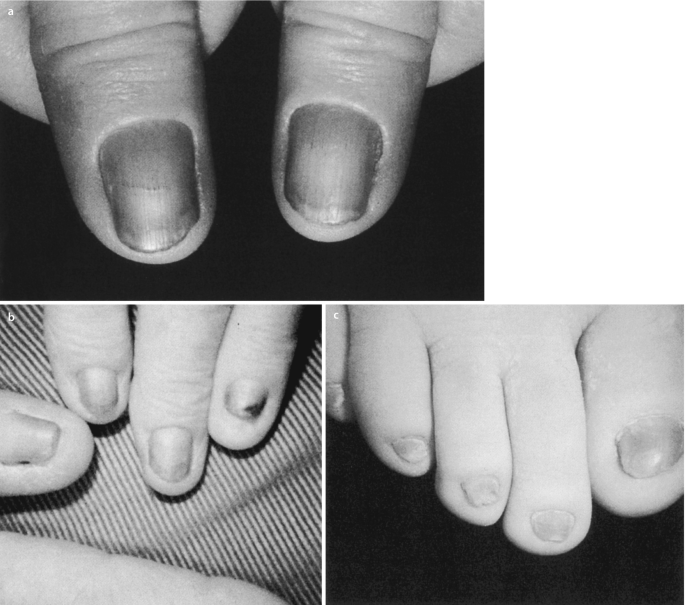 Grey pigmentation of the fingers and nail plates in their entirety |  Download Scientific Diagram
