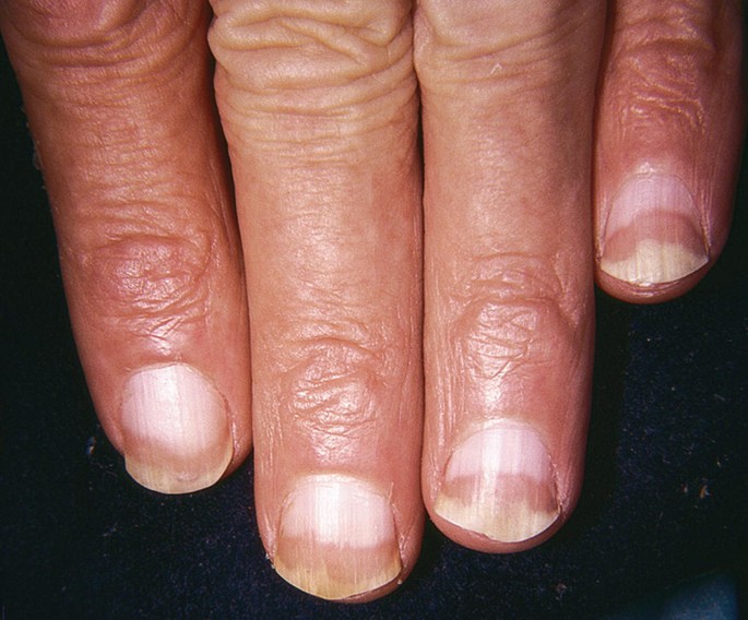 Figure 1 from Plummer's nails (onycholysis) in an adolescent nigerian girl  with hyperthyroidism due to Graves' disease | Semantic Scholar