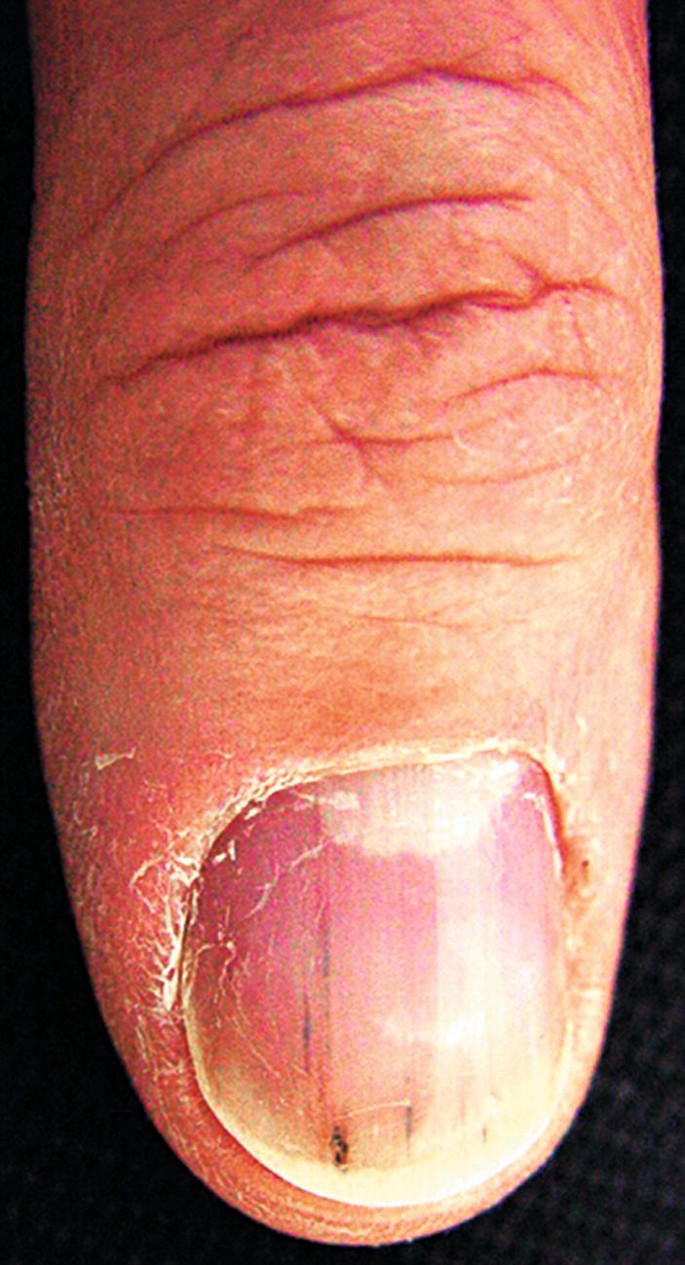 Nails in Systemic Disease | SpringerLink