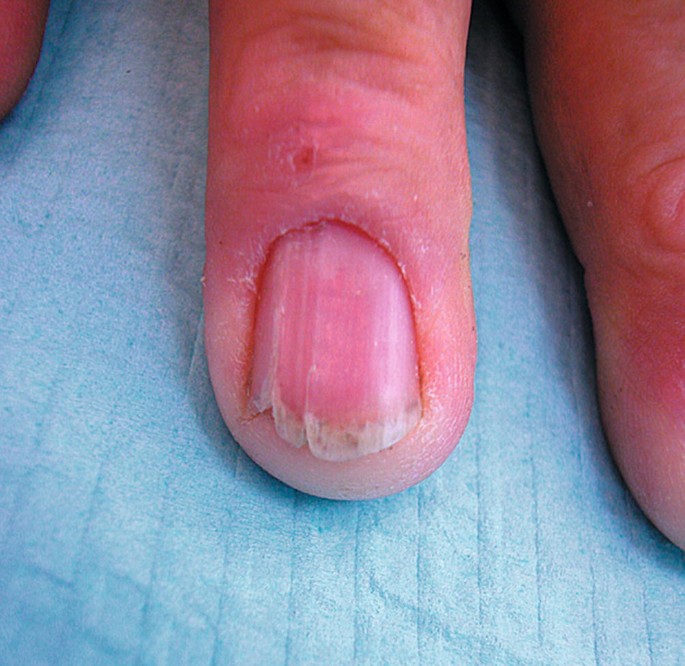 Onycholysis: Symptoms, causes, and pictures