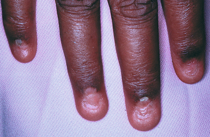 Nails in Systemic Disease | SpringerLink