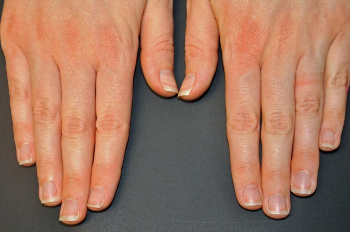 Yellow nail syndrome - Dermatology Advisor