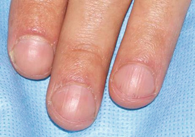 Lines on Nails: Here is What They Indicate - HealthKart