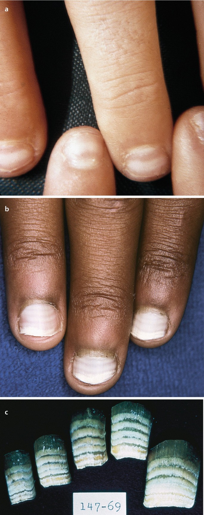 Blue nevus of the nail: A case report and review - Satolli - 2020 -  Dermatologic Therapy - Wiley Online Library