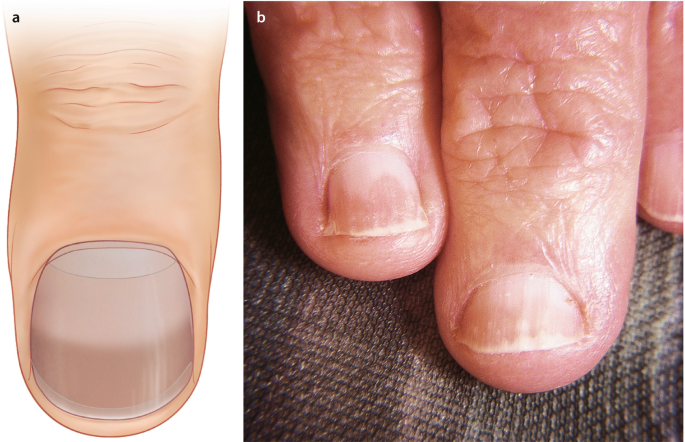 PDF) Nail disorders and systemic disease: what the nails tell us | George  Larios - Academia.edu