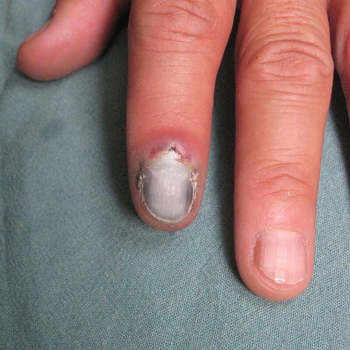 Clinical characteristics and management outcomes in isolated nail lichen  planus: A retrospective case series - Indian Journal of Dermatology,  Venereology and Leprology