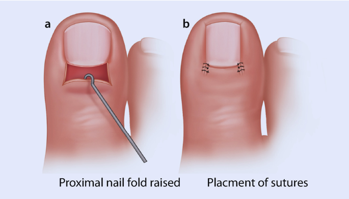 Surgical Treatment of Onychocryptosis | SpringerLink Surgical Treatment of Onychocryptosis | SpringerLink