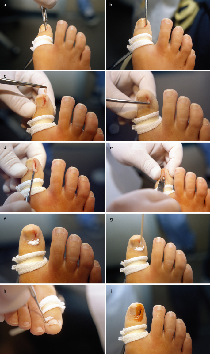Ingrown toenail treatment | informedhealth.org