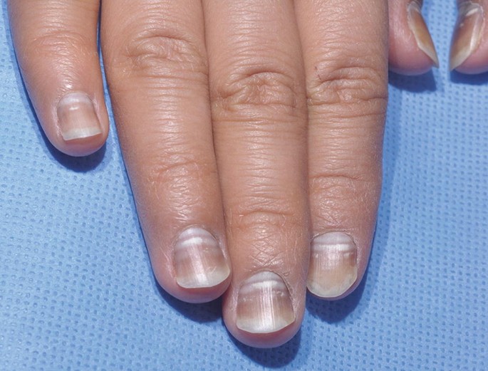 Median Nail Dystrophy of both Thumbs