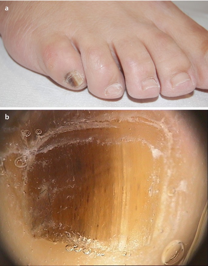 Nail Dystrophy in Patients with Atopic Dermatitis and Its Association with  Disease Severity