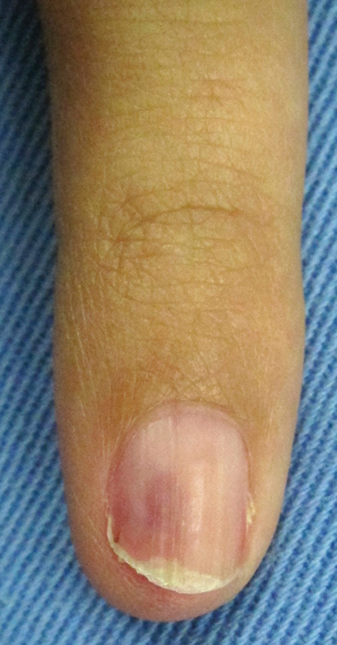 DBMCI Egurukul - Dorsal pterygium occurs when the proximal nail folds fuse  with the underlying matrix and, subsequently, with the nail bed. As a  result, the nail plate is divided into 2