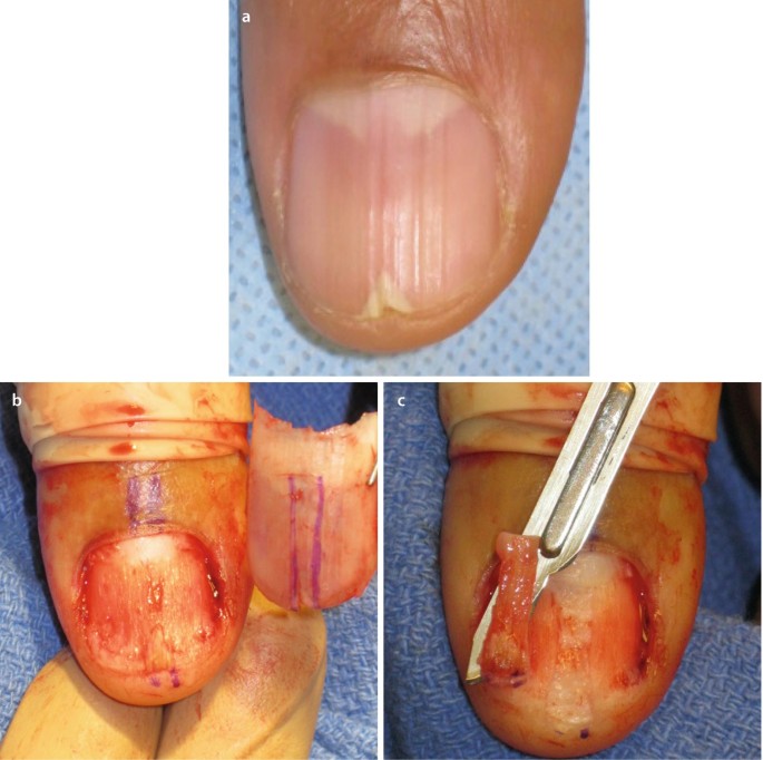 Basic and Intermediate Complexity Nail Procedures | SpringerLink Basic and Intermediate Complexity Nail Procedures | SpringerLink