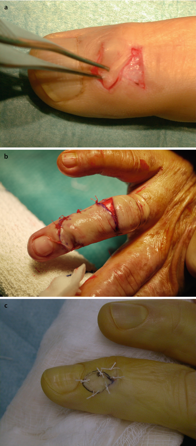 Clinical, dermoscopic, and histopathological evaluations of patients with  nail disorders - Abu El‐Hamd - 2022 - Journal of Cosmetic Dermatology -  Wiley Online Library