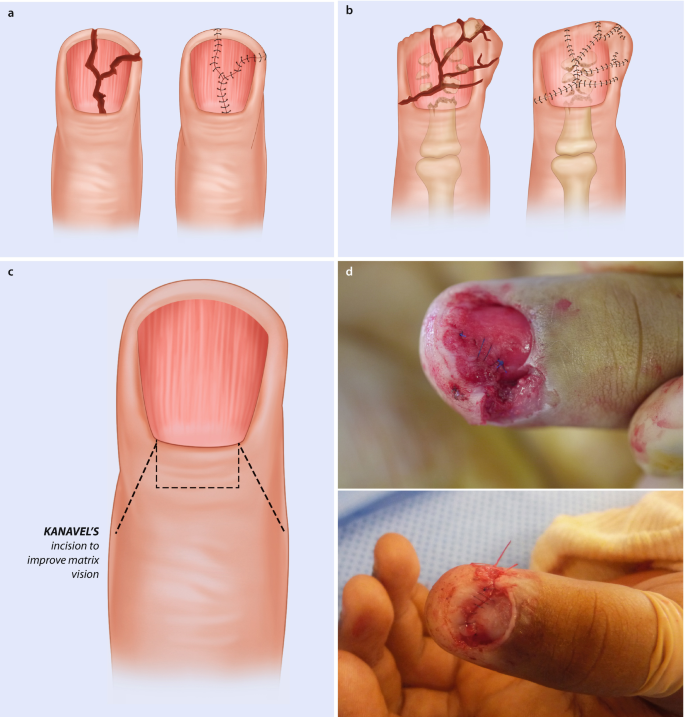 Therapeutic outcomes of one‐minute application of sodium hydroxide versus  phenol in the chemical cauterization of ingrown toenails - Gundogdu - 2022  - Journal of Cosmetic Dermatology - Wiley Online Library