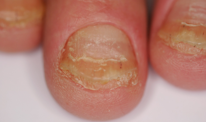 Systemic Therapy for Nail Psoriasis