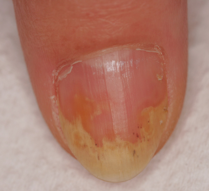 Dermoscopy: the ultimate tool for diagnosis of nail psoriasis? A review of  the diagnostic utility of dermoscopy in nail psoriasi