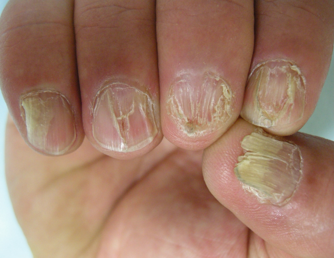 JCM | Free Full-Text | Oral Mucosa and Nails in Genodermatoses: A  Diagnostic Challenge