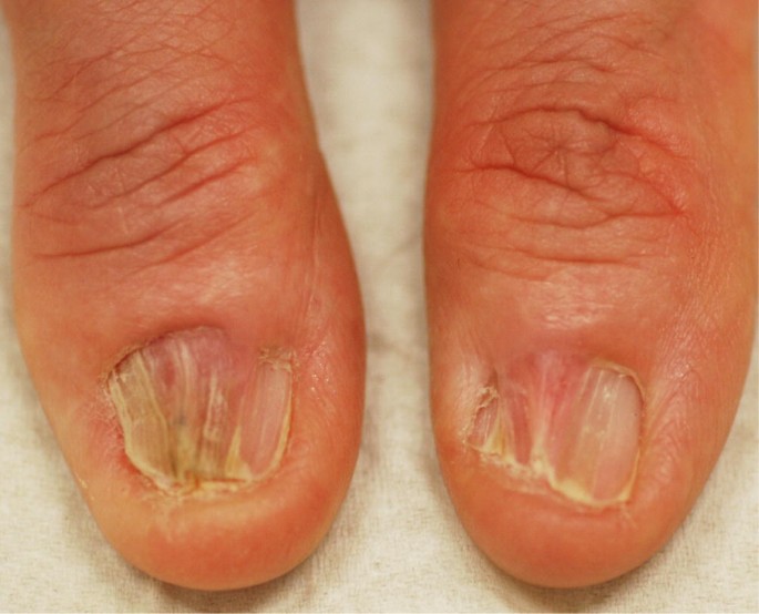 Frontiers | Successful treatment of nail lichen planus with tofacitinib: a  case report and review of the literature