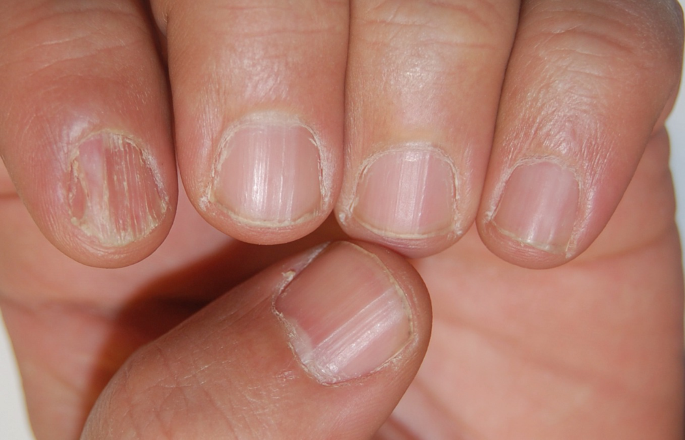 Lichen Planus Nails - 10 Best Homeopathic Treatment