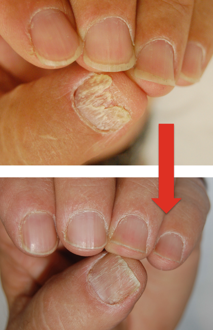 Nail Dystrophy Solutions | Top Clinic for Effective Treatment