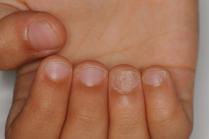 Frontiers | Case report: Green nail syndrome in an epidemic prevention  volunteer during the outbreak of the Omicron in Shanghai