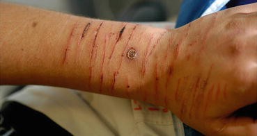do cigarette burns leave scars Inflicted Cutaneous Lesions and Burns: The Skin