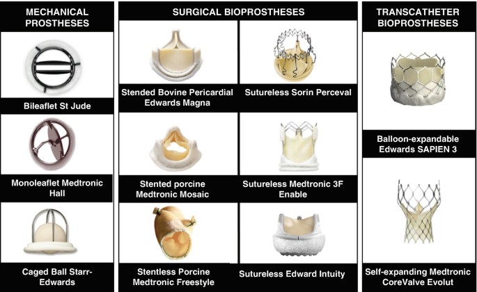 Multimodality Imaging Assessment of Prosthetic Aortic Valve | SpringerLink