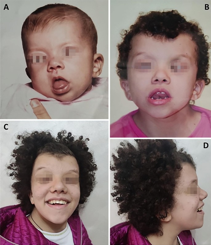 Cardiofaciocutaneous Syndrome (CFC): Types 1–4 | Springer Nature Link