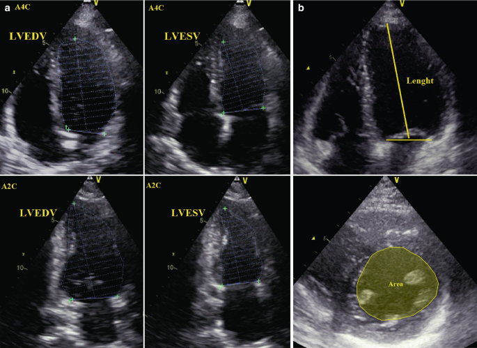 Summary of Cardiac Chamber Quantification in Adults by Echocardiography |  SpringerLink