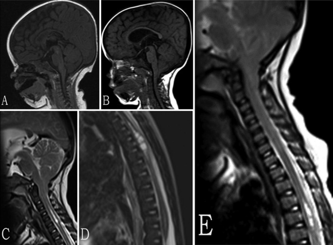 Imaging of Spinal CSF Disorders: Syringomyelia | SpringerLink