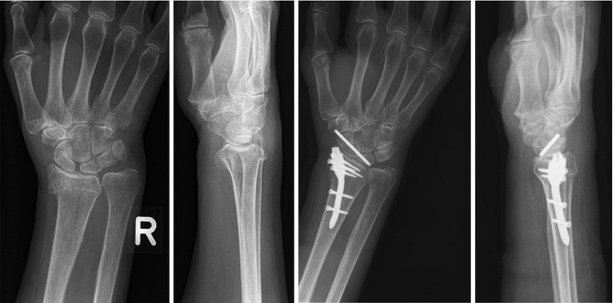 Colles fracture (Pouteau fracture), Radiology Case