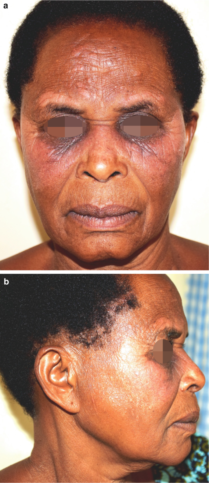 melanotic lupus erythematosus Lupus Erythematosus in Pigmented and Black Skin