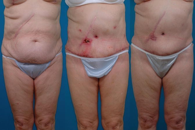 Abdominoplasty and Liposuction Thighs and Flanks Case 92109 - The Plastic  Surgery Group