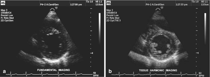 Regional wall motion abnormalities in coronary artery disease – All About  Cardiovascular System and Disorders