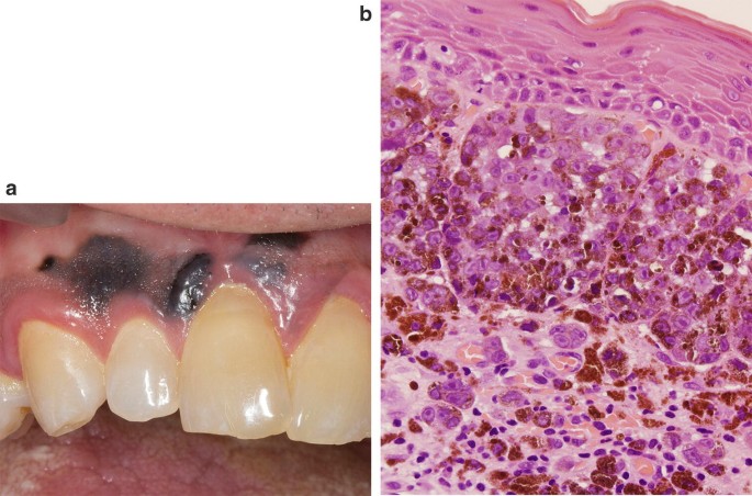 face is hot after melanotan 2 injection Changes in Oral Mucosa Associated with Melanotan II Injections: A Case  Report