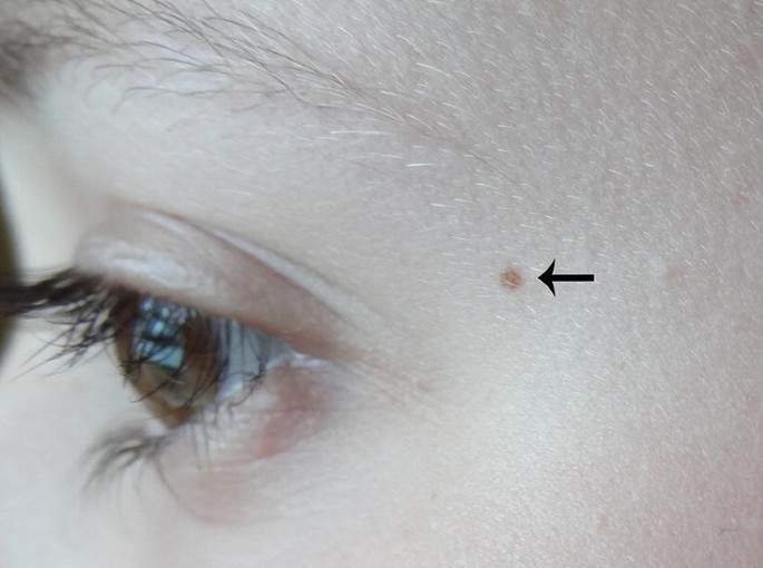 Pigmented Lesions of the Oral Mucosa