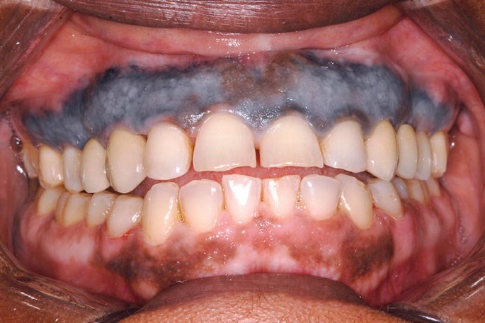 dark melanotic line along gingival margin in dark skin people Pigmented Lesions of the Oral Mucosa